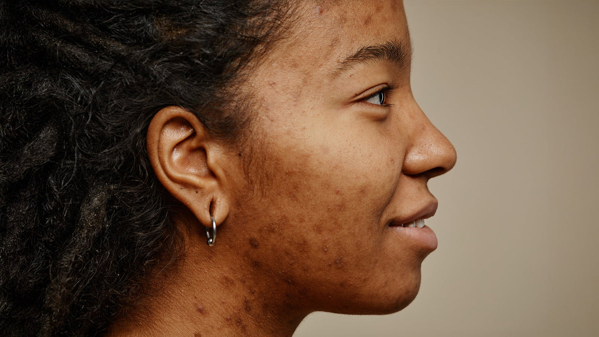 Hyperpigmentation Routine 2025: A Clean Beauty Guide to Even-Toned Skin